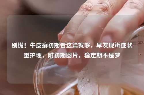 别慌！牛皮癣初期看这篇就够，早发现辨症状重护理，附初期图片，稳定期不是梦